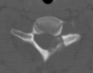 Osteoblastoma CT 2